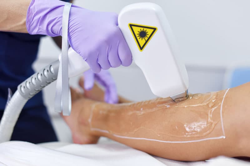 Depilación definitiva